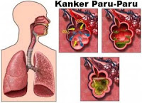 Image Obat Herbal Paru Paru Tbc